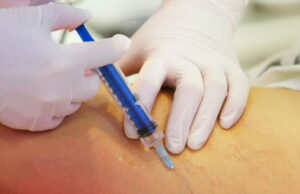 SUS oferece novo método de tratamento gratuito para varizes; veja dicas para evitar vasinhos, varizes e causas SUS oferece novo método de tratamento gratuito para varizes; veja dicas para evitar vasinhos, varizes e causas